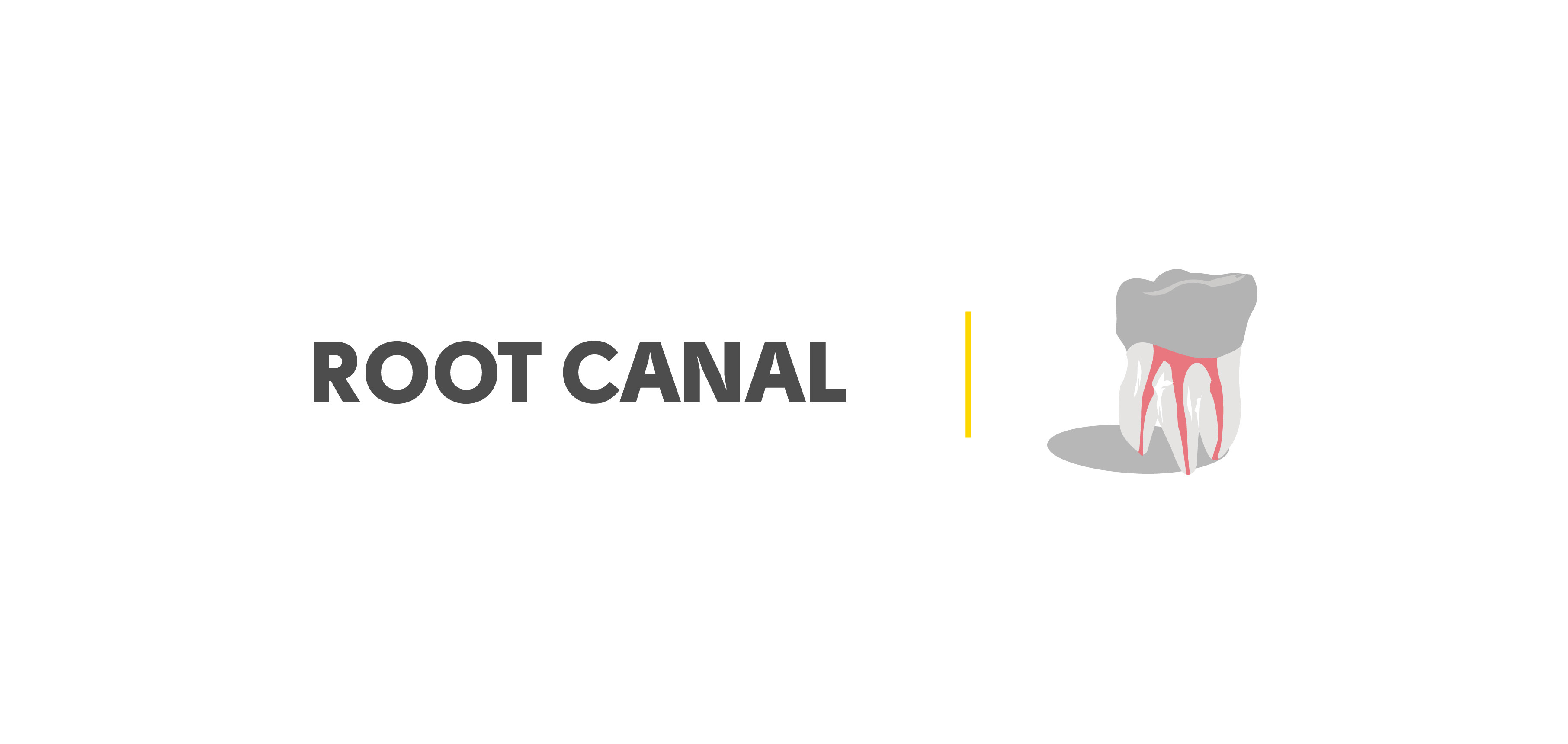 Root Canal Sealer